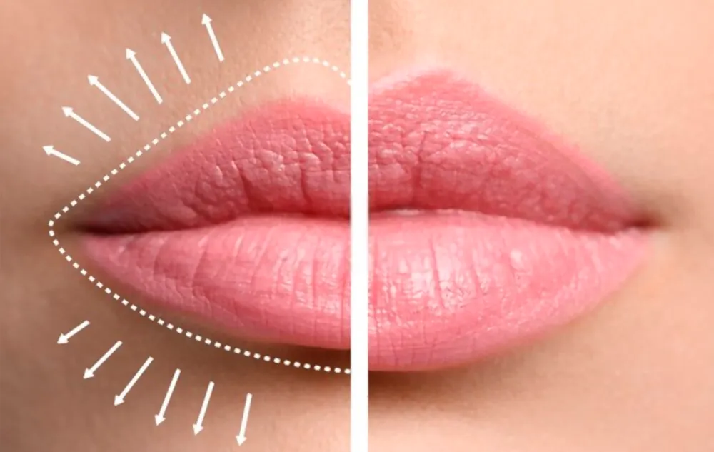 aumento de labios - comparación