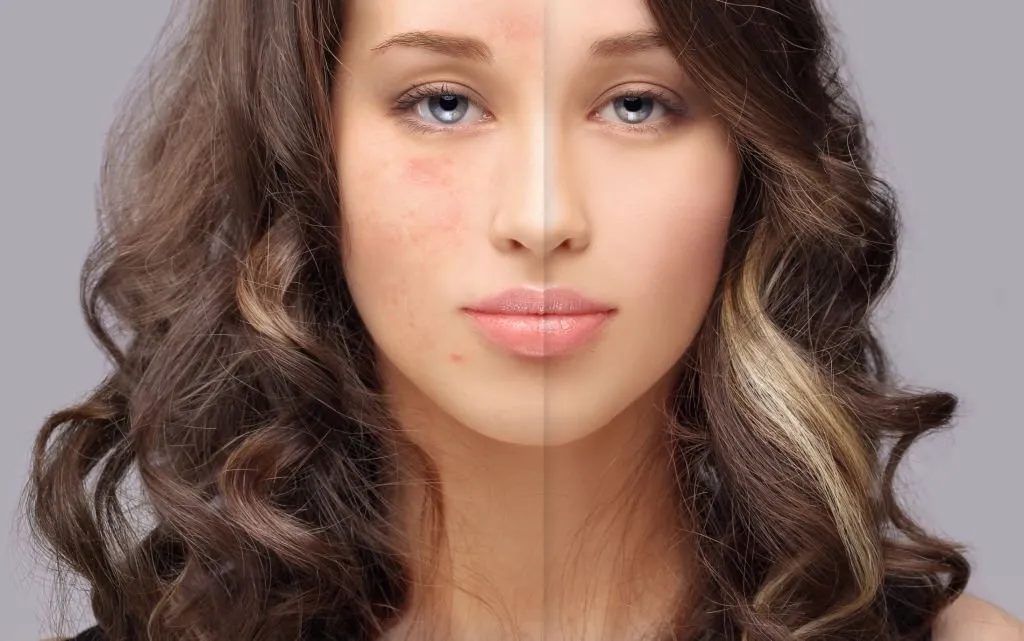 comparativa de mujer con manchas en la piel antes, y sin manchas cutáneas después de un tratamiento de Medicina Estética