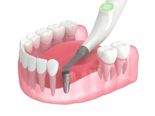 Representación 3D de la mandíbula con tapa de curación enterrada y detector de implantes inteligente.