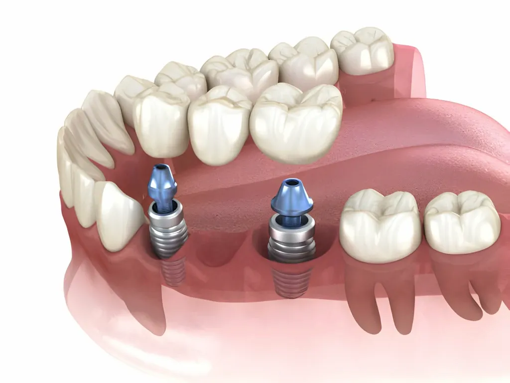 dos coronas colocándose sobre sus respectivos pilares en un implante dental