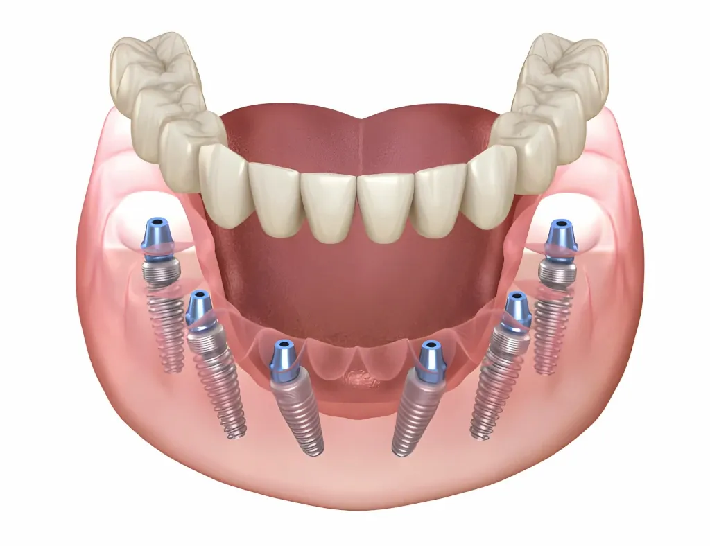 Reconstrucción digital de una mandíbula con implantes dentales