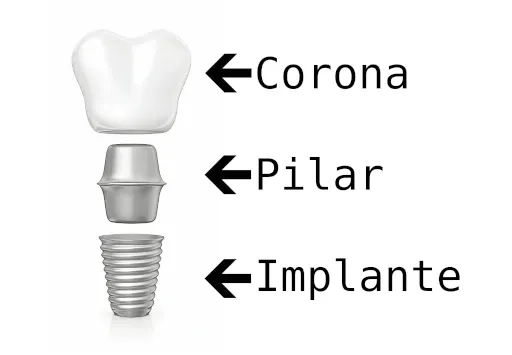 Esquema de las partes de un implante dental: corona, pilar e implante.