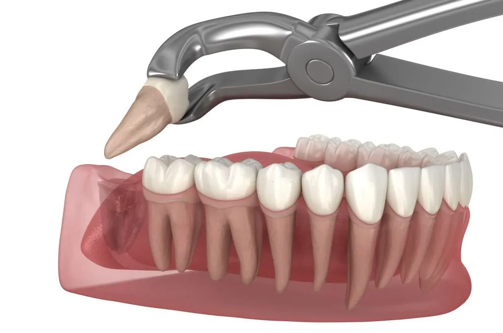 ilustración de una muela del juicio extraída con alicates de extracción de dientes